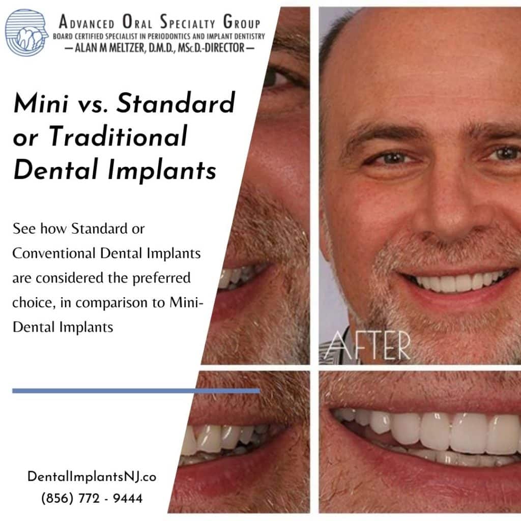 Mini vs Standard Dental Implants: Which is prefered?