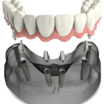 full arch dental implants model Voorhees, NJ