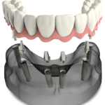 full arch dental implants model Voorhees, NJ