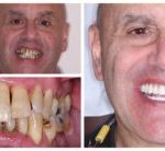 Patient Joe's Full Mouth Restoration - DentalImplantsNJ.co
