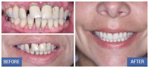 Patient Julie's Full Mouth Restoration - DentalImplantsNJ.co
