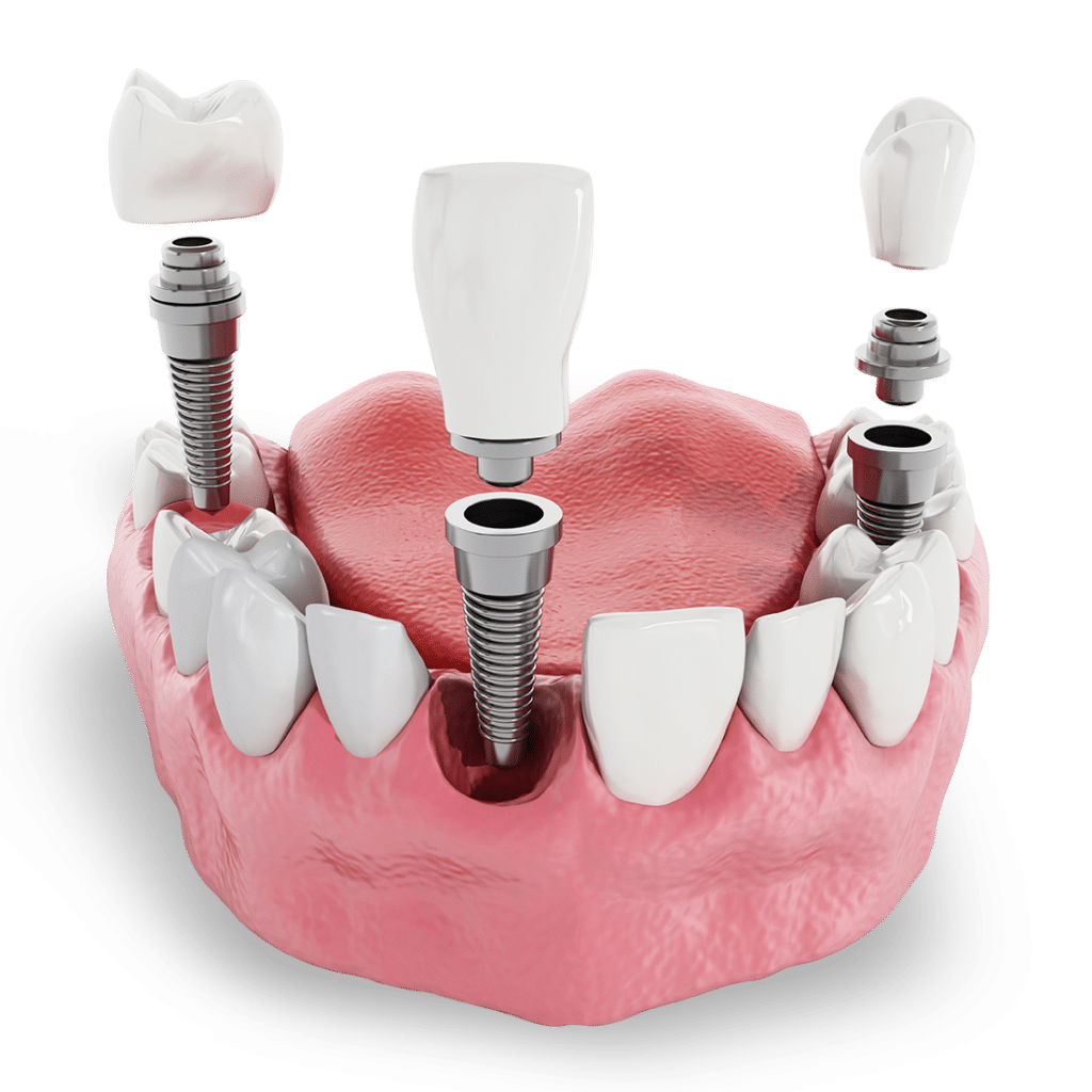 Dental Implant Single Tooth Replacement Visual