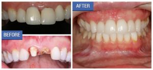 Patient Stacey's Full Mouth Restoration - DentalImplantsNJ.co
