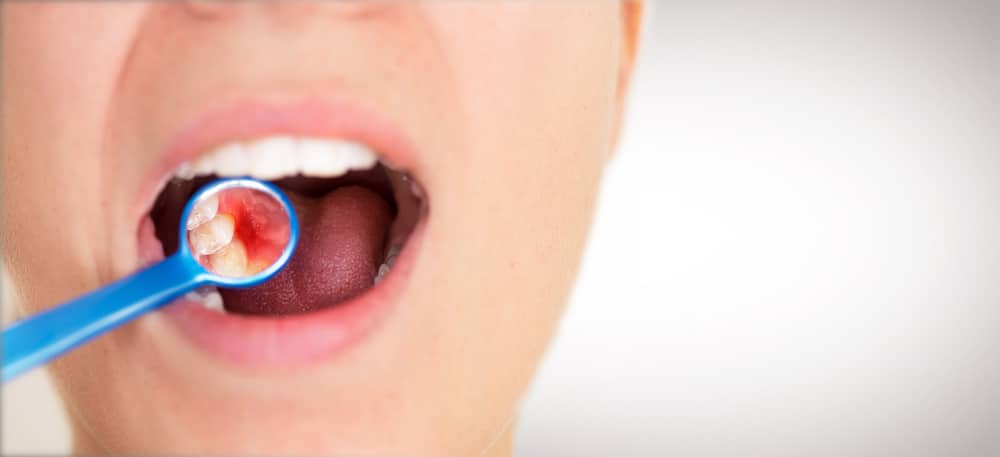 periodontal disease