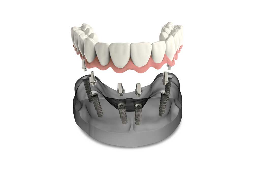a model of implant supported dentures