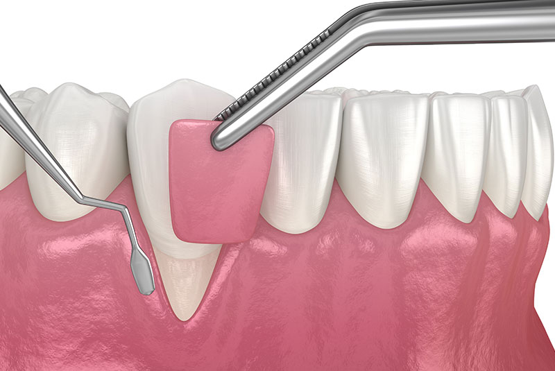 gum grafting procedure