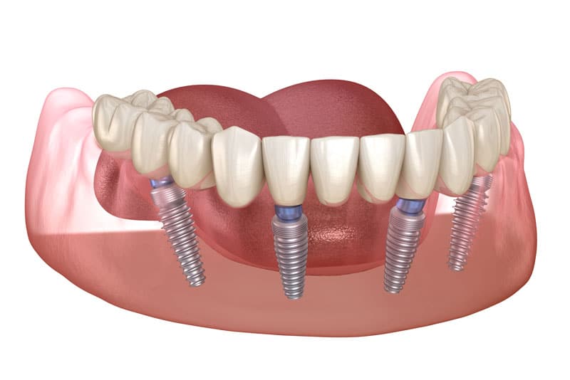 a graphic image of All-On-4 dental implants that show how the four accurately placed dental implants support the prosthesis for a new and improved smile.