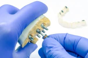a custom dental implant model being customized by a dental professional.