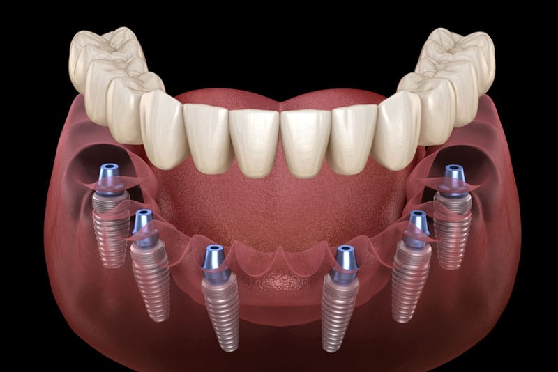 New Smile Today Same Day Dental Implant Graphic
