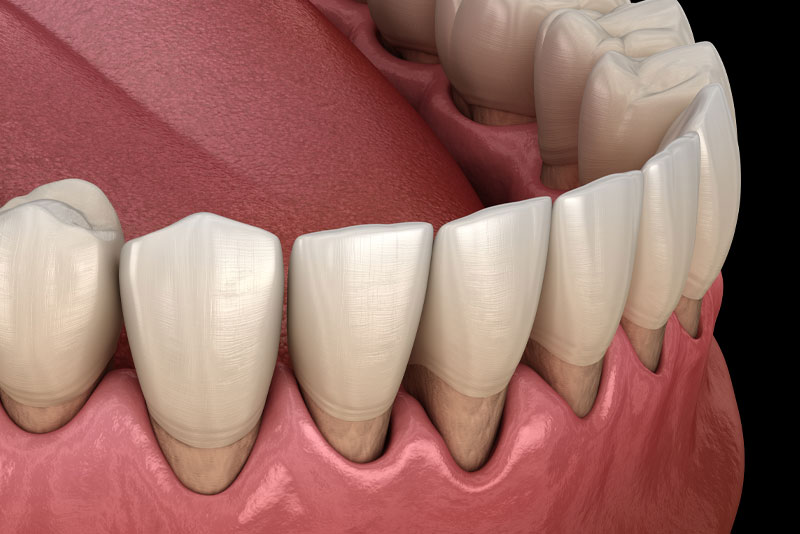 Dental Patient Suffering From Gum Recession Graphic