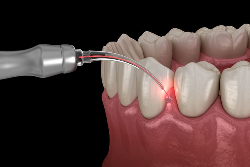 Periodontal Laser Being Used On Gums Black Background